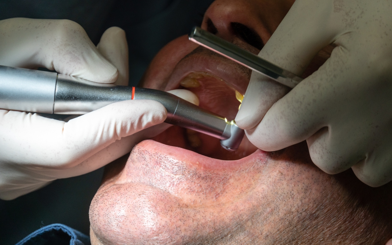 Can Dental Implants Be Used for a Full Mouth Restoration Can Dental Implants Be Used for a Full Mouth Restoration