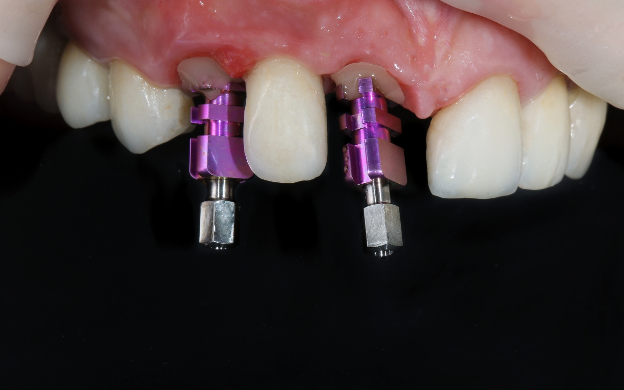 Understanding Abutment Implants: An In-Depth Guide to Dental Implants