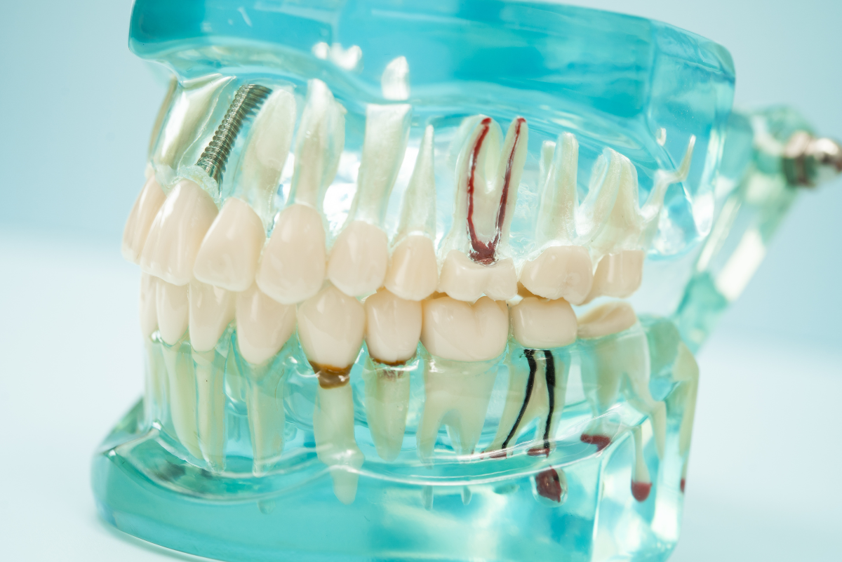 Are Root Canals Painful_ A Duxbury Dentist’s Perspective Are Root Canals Painful? A Dentist’s Perspective