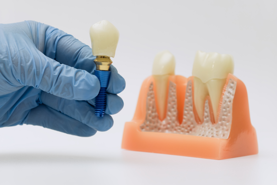 Can Smokers Get Dental Implants_ Risks and Realistic Outcomes Smokers Get Dental Implants