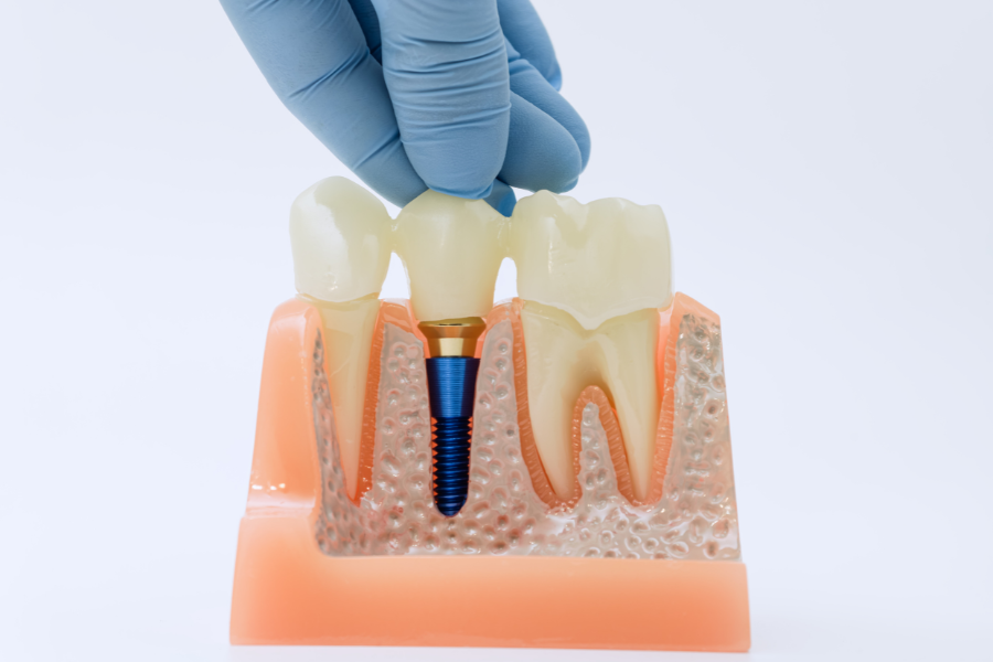 How Long Do Dental Implants Last With Proper Care Dental Implants